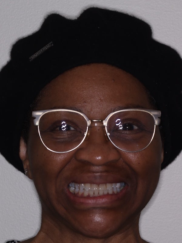 Ortho Full Face After