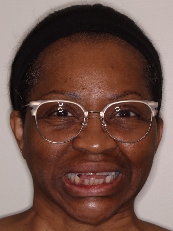 Ortho Full Face Before