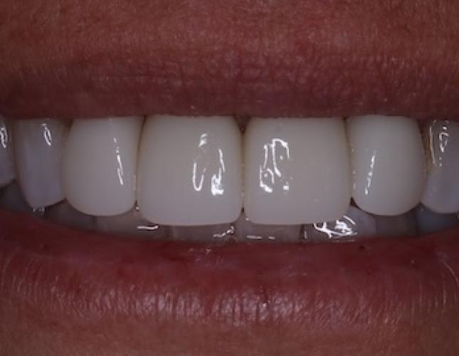 Implant Crown After
