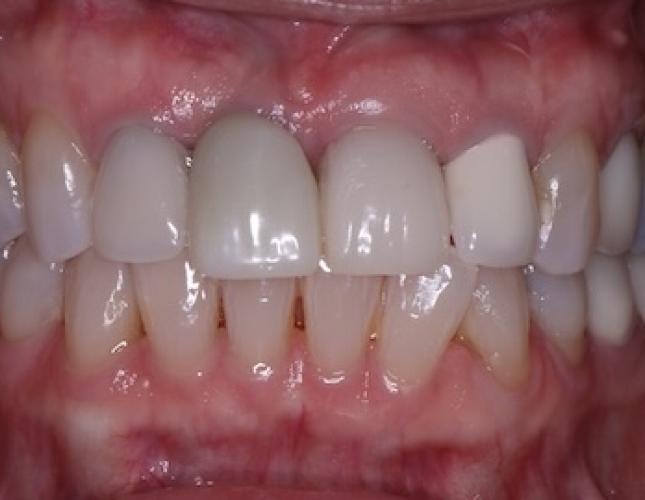 Implant Crown Before