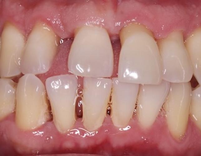 Implant Crowns 2 Before