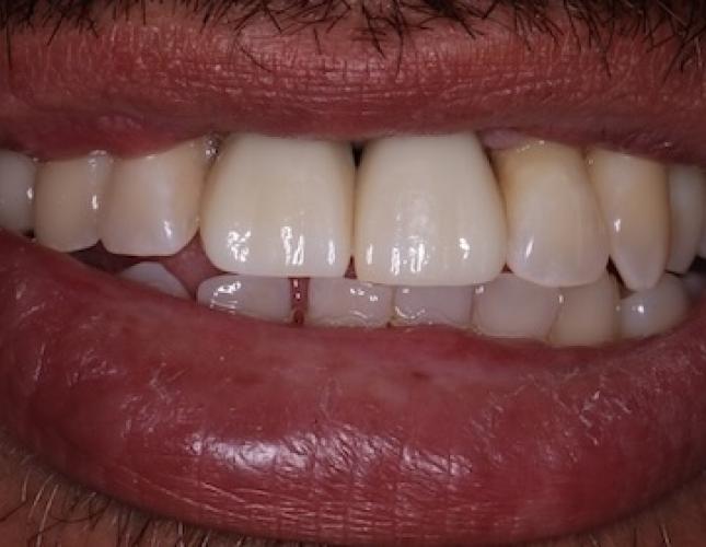 Implant Crowns 2 After