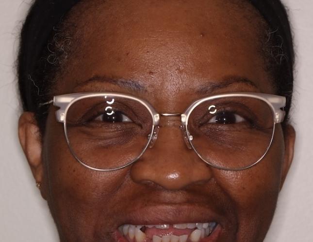 Ortho Full Face Before