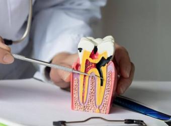 What to Expect During a Root Canal